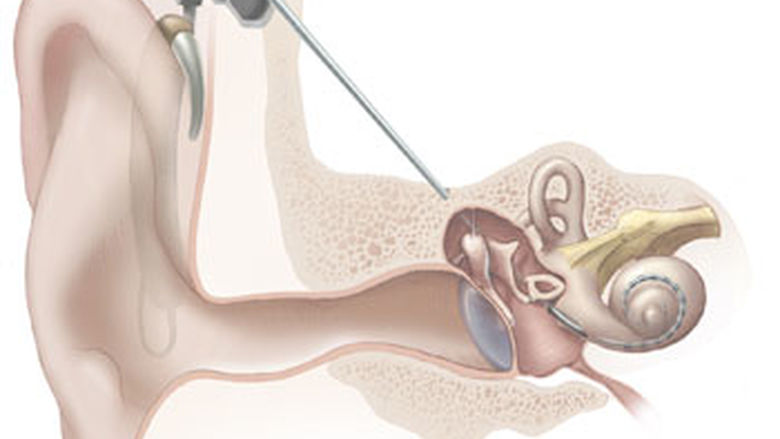 cochlear implant